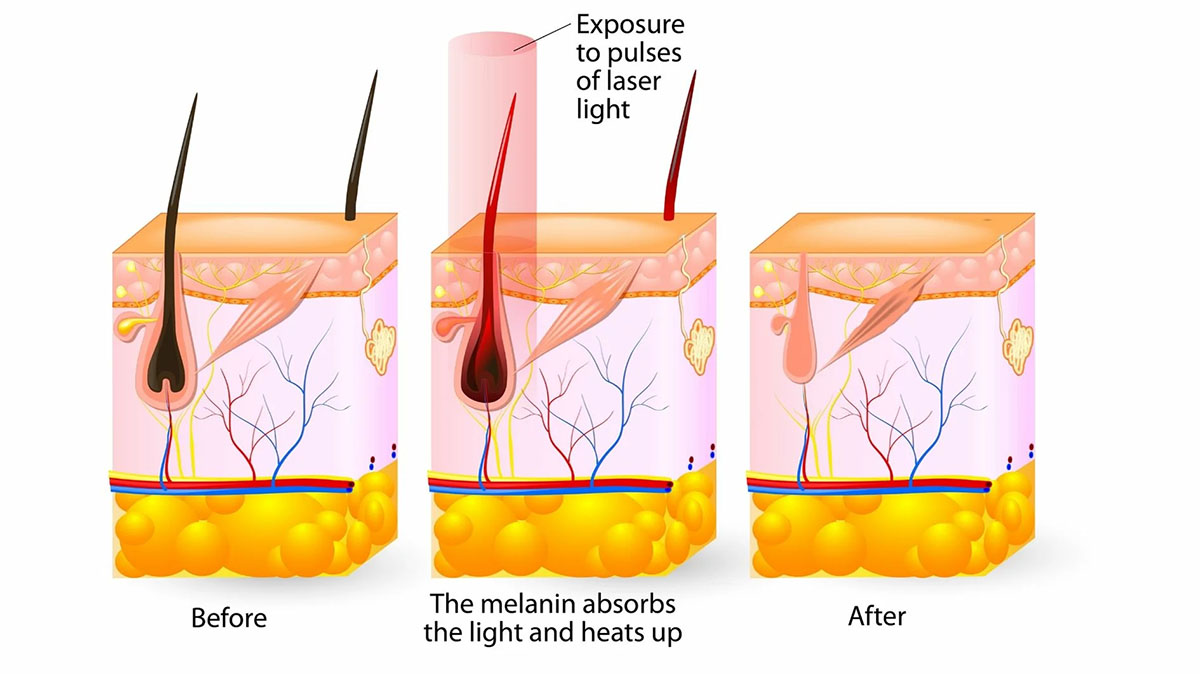 How laser removal works