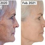 Judy Murray before and after photos from microneedling