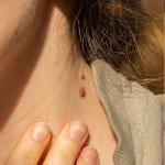 Image shows skin tag on neck